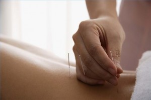 acupuncture